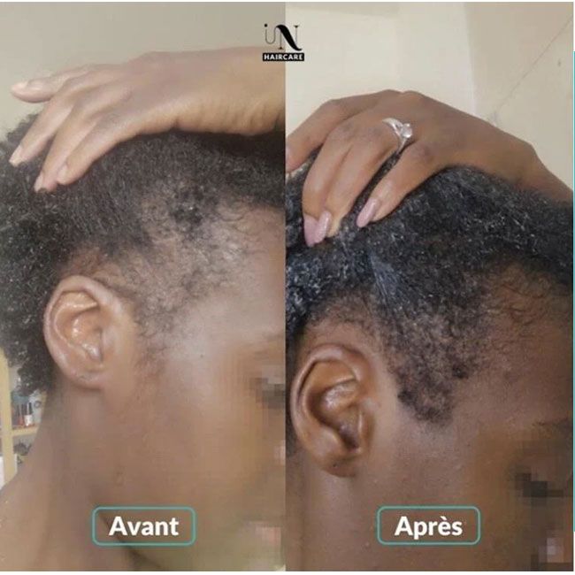 Pousse cheveux compléments alimentaires gummies In Haircaire application