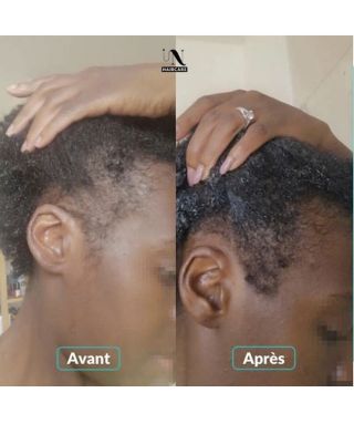 Gummies cure pousse de cheveux