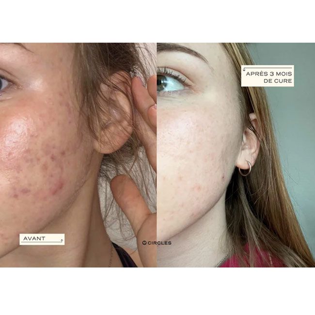 Circles' Detox & hormonal acne resultat