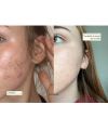 Circles' Detox & hormonal acne resultat