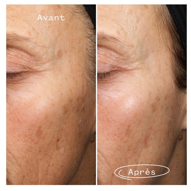 Serum anti tache brune Pai Skincare resultat