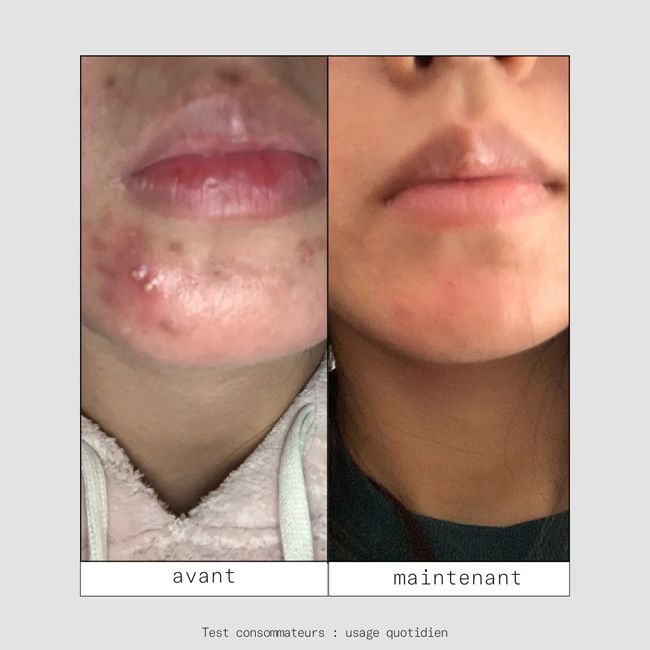Complément alimentaire naturel CLEAR IN stop-boutons Skin & Out Résultats