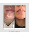 Skin & Out's Natural food supplement CLEAR IN stop-boutons Results