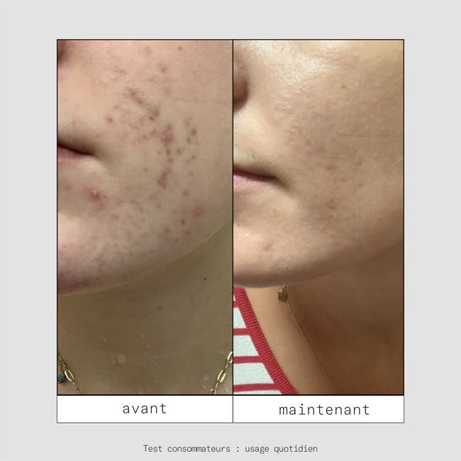 Soin anti-imperfections EVENT OUT anti-taches Skin & Out Résultats