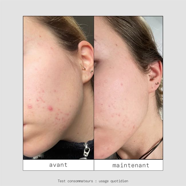 Skin & Out's CLEAR OUT Anti-blemish patch Results