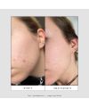Skin & Out's CLEAR OUT Anti-blemish patch Results