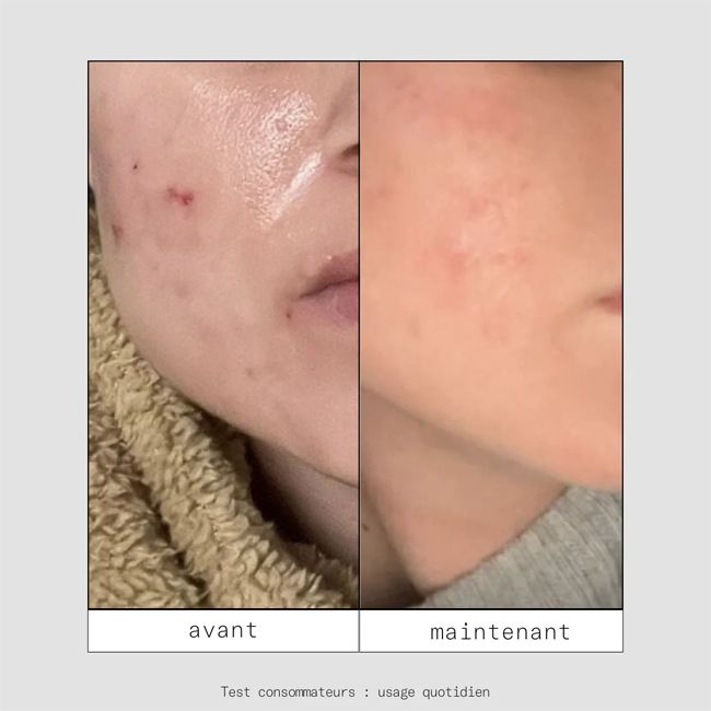 Coffret soin MINI SHTARS routine spéciale boutons Skin & Out Résultats