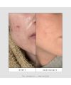 Coffret soin MINI SHTARS routine spéciale boutons Skin & Out Résultats