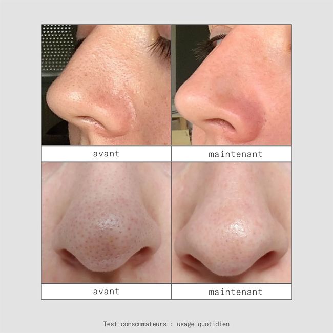 Patch nez naturel purifiant PEEL OUT Skin & Out Résultats