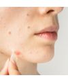 Patch anti-boutons micro aiguilles CLEAR OUT Skin & Out Application