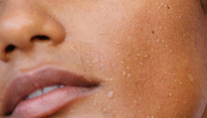 Dehydrated Skin